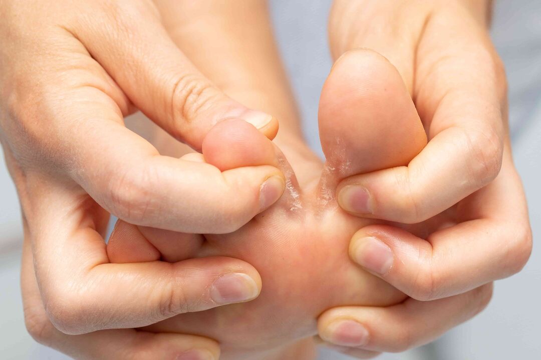 Fungi between the toes and its treatment with Demyxil cream