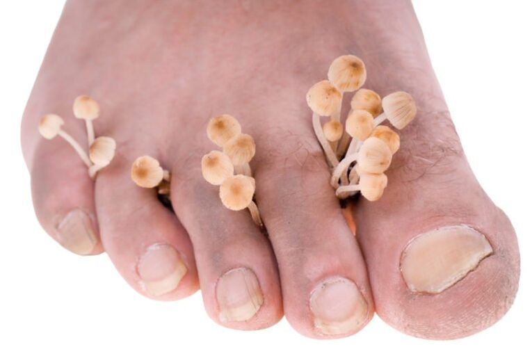 fungus of the symptoms of the legs