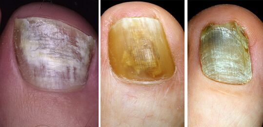 In the photo change in the color of the toenails with a fungal disease