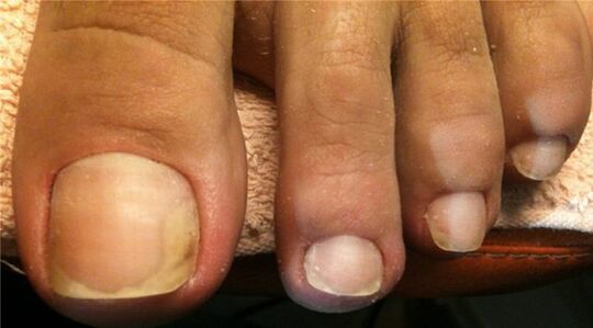 Nail fungus