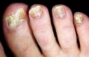 toenail fungus symptoms