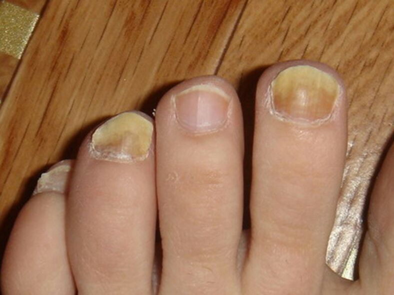 fungal infection of the toenails