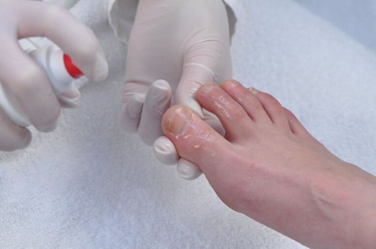 treatment of the nail plate from a fungal infection